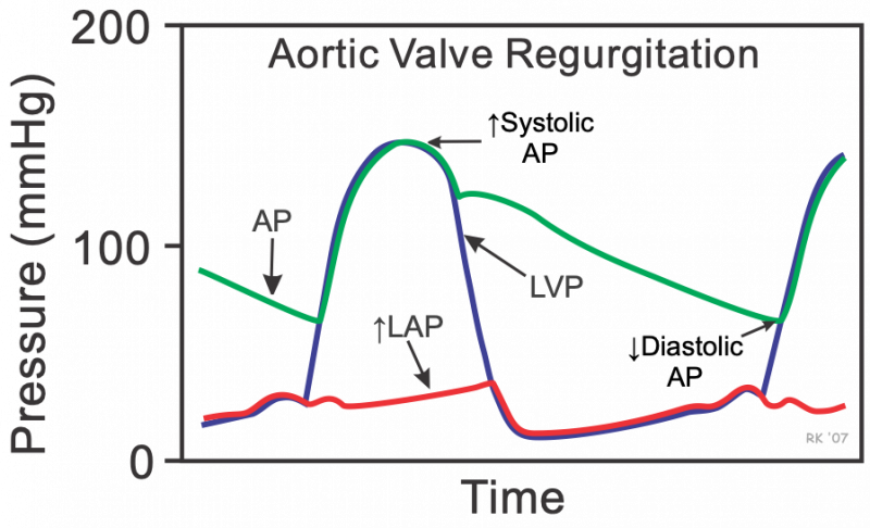 Aortic valve regurgitation cardiac pressure tracings