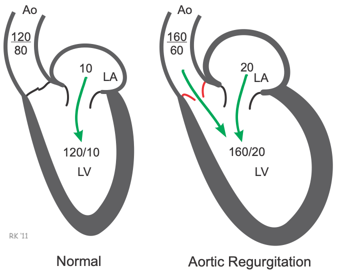 Aortic valve regurgitation cardiac pressures