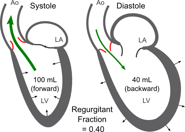 Regurgitant fraction in aortic valve insufficiency