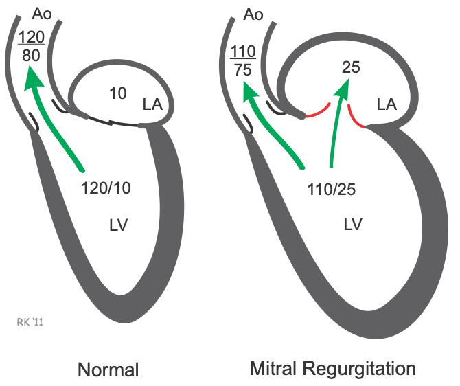 Mitral valve regurgitation