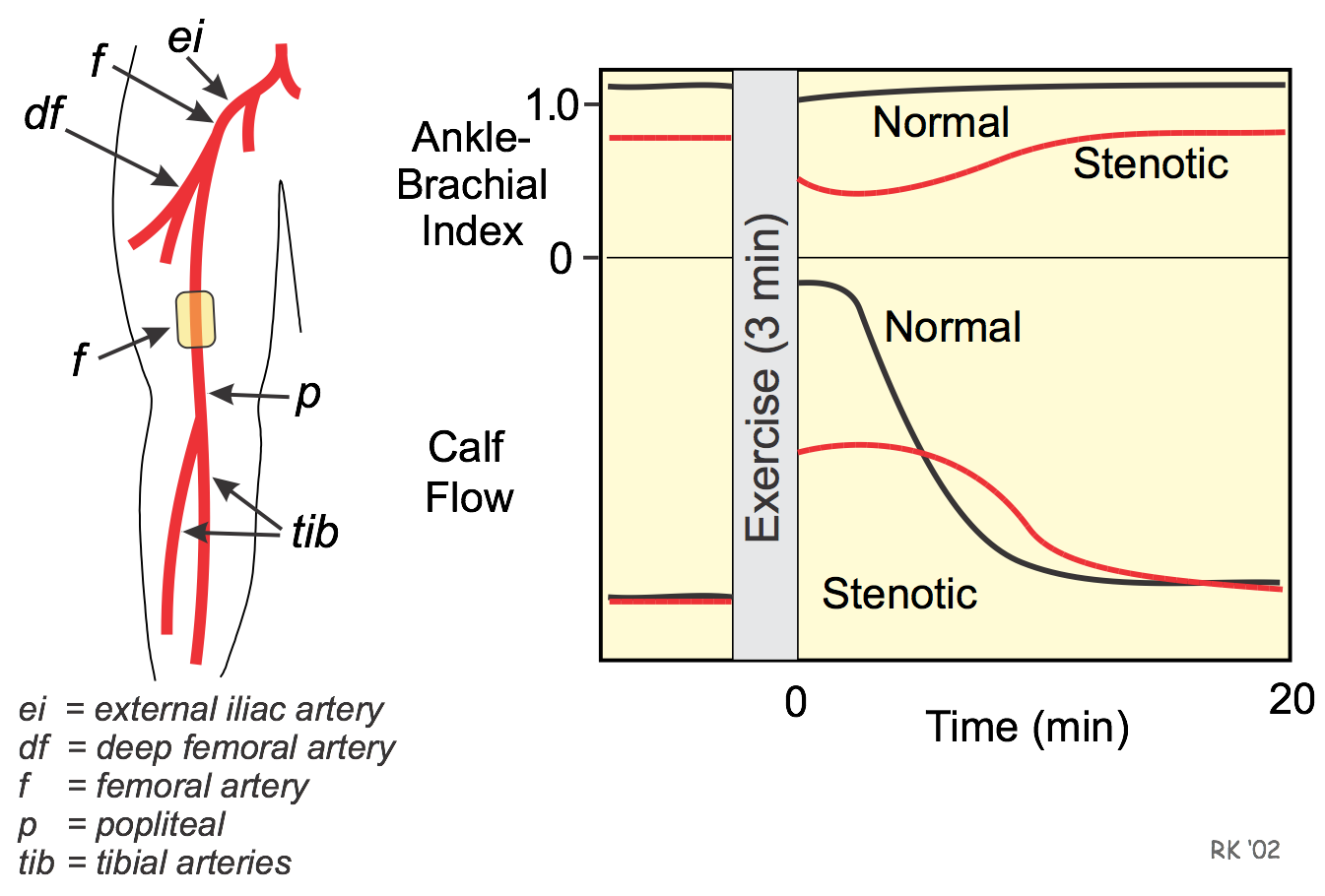 Hemodynamics of single arterial stenosis
