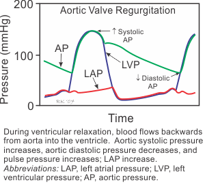 aortic valve regurgitation
