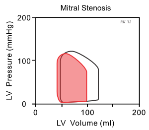 mitral valve stenosis