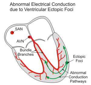 ventricular ectopic foci