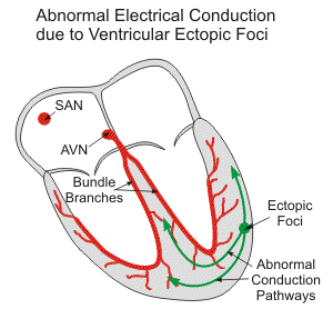 atrial and ventricular ectopy