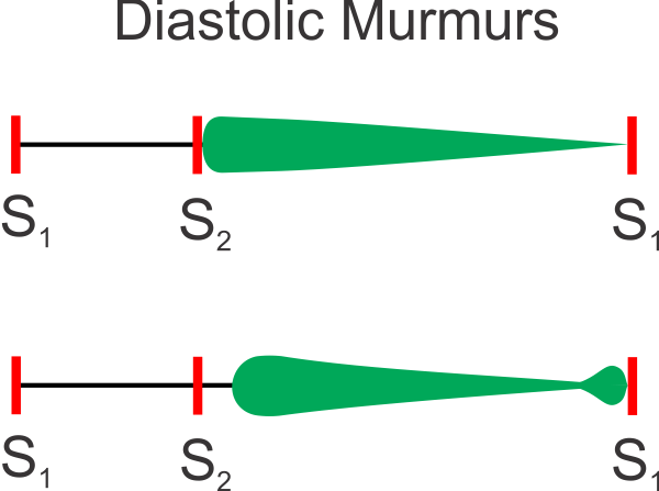 summary of cardiac murmurs