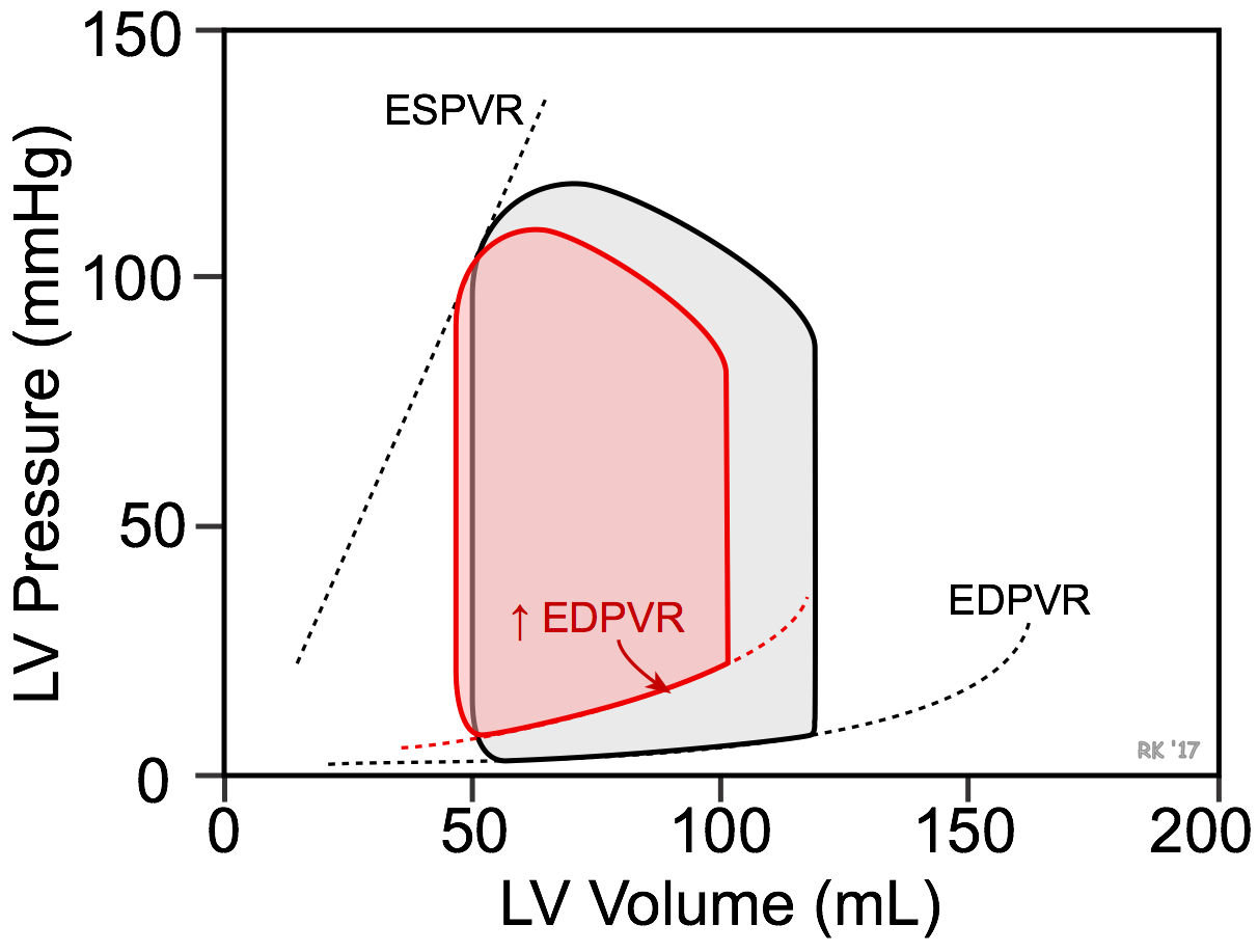 Ventricular diastolic dysfunction pressure-volume loop